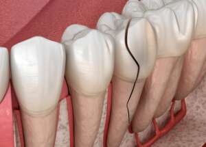 Tooth Fracture: Immediate Steps and Long-Term Solutions