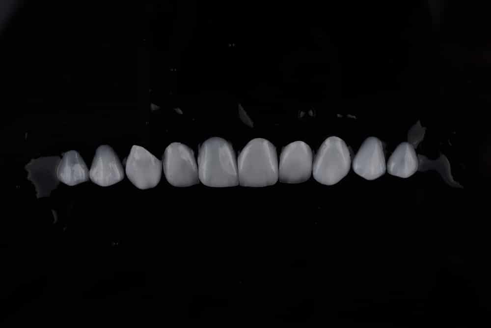 Are Emax Veneers Stain-Resistant and Do They Stay White Over Time?