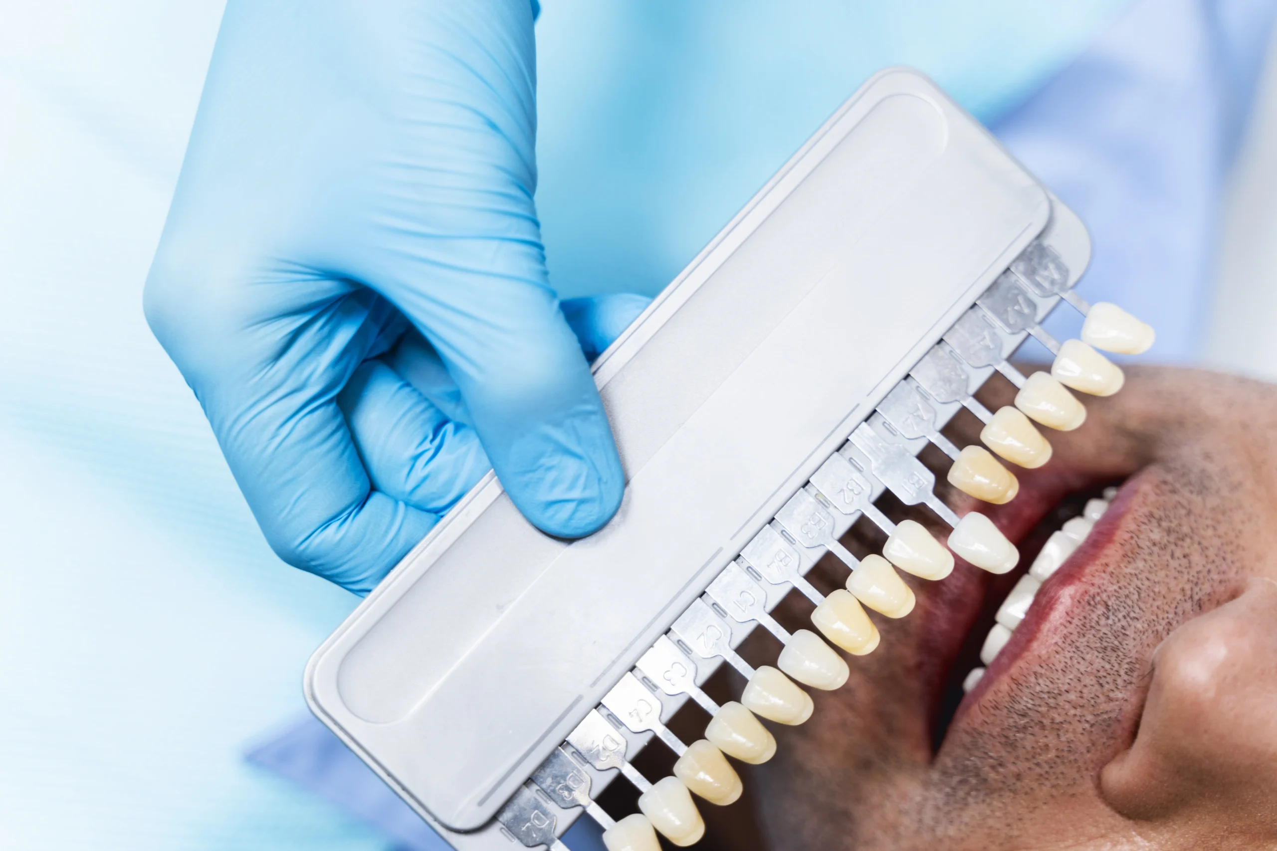 How Zirconia Veneers Transform Your Teeth