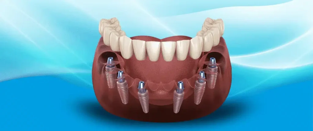 All-on-6 Dental Implants in Turkey- The Ultimate Guide to Your New Smile Dental Harmony Turkey Blog