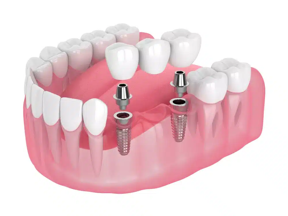 Comparing Implant Bridges