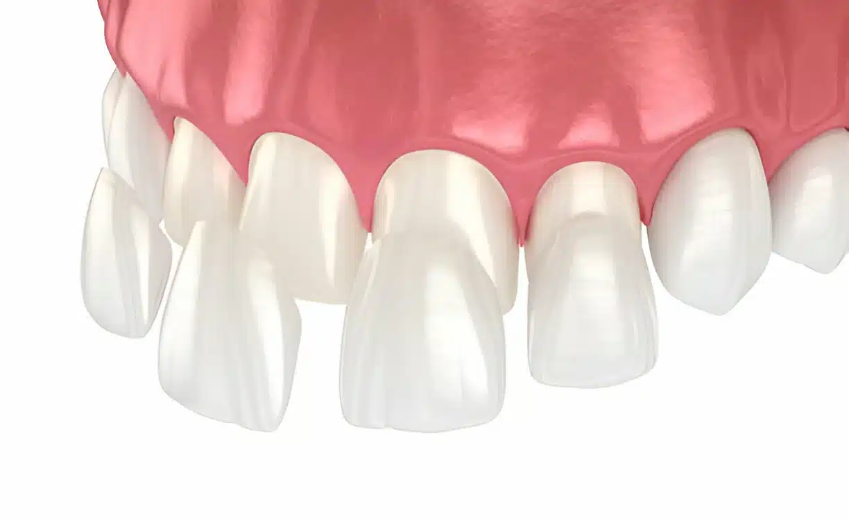 E.Max Veneers vs Composite Bonding- Which Is Better for You Dental Harmony Turkey Blog