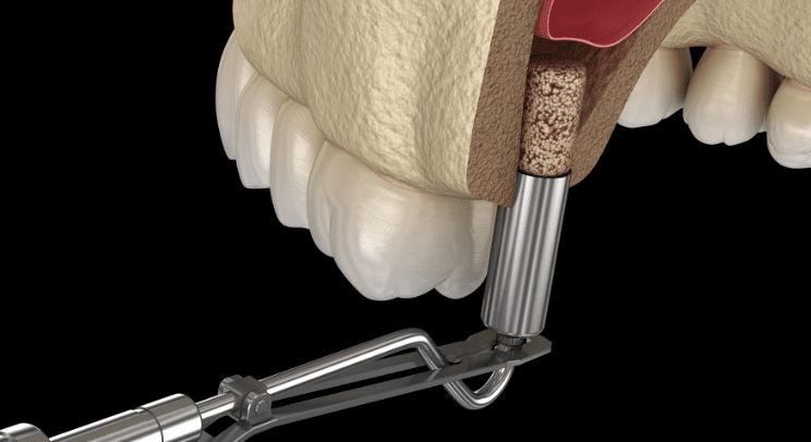 Bone Grafting