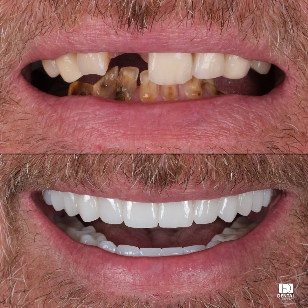 Dental Implants 1