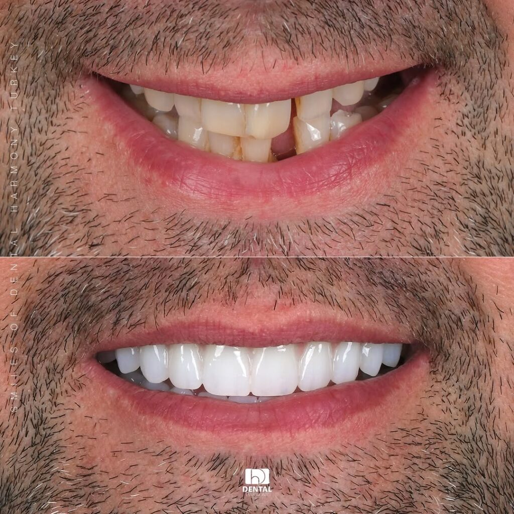 Dental Implants 2