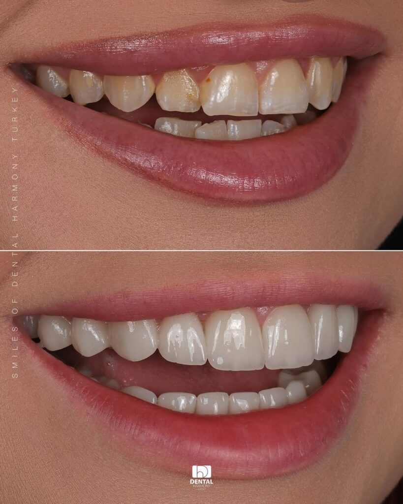 E.Max Laminate Veneers 3