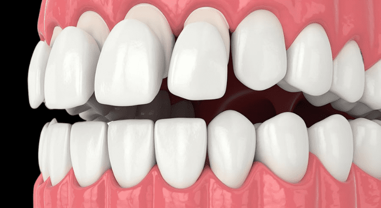 composit-veneer-treatment